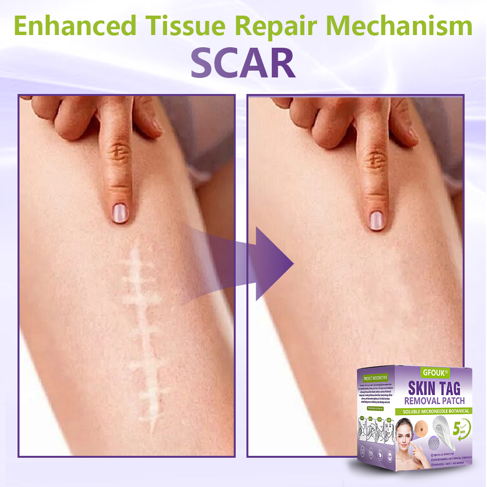 Made and Shipped from Canada ✨GFOUK® Soluble Microneedle Botanical Skin Tag Removal Patch