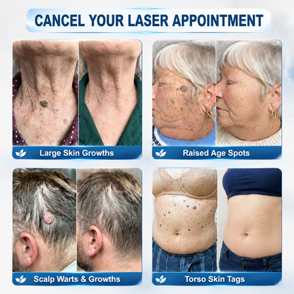 Made and Shipped from CA ✨Evolvion® 𝟕-𝐃𝒂𝘆 𝐒𝗸𝐢𝐧 𝐓𝒂𝗴 & 𝐒𝐩𝙤𝐭 𝐄𝐫𝒂𝐬𝙚𝐫 Painless & Scar-Free Advanced Imperfection Remova𝗜 Ro𝗜𝗜erba𝗜𝗜 Pen