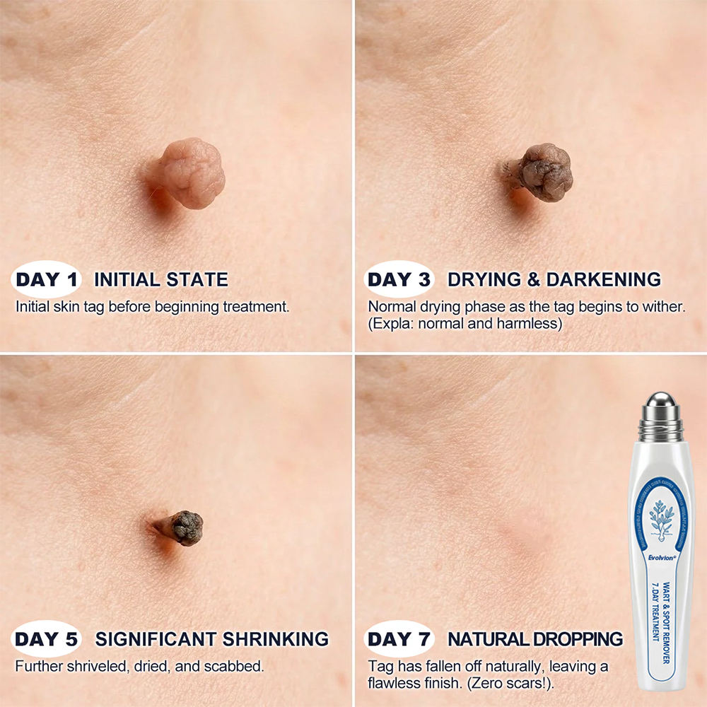 Made and Shipped from CA ✨Evolvion® 𝟕-𝐃𝒂𝘆 𝐒𝗸𝐢𝐧 𝐓𝒂𝗴 & 𝐒𝐩𝙤𝐭 𝐄𝐫𝒂𝐬𝙚𝐫 Painless & Scar-Free Advanced Imperfection Remova𝗜 Ro𝗜𝗜erba𝗜𝗜 Pen