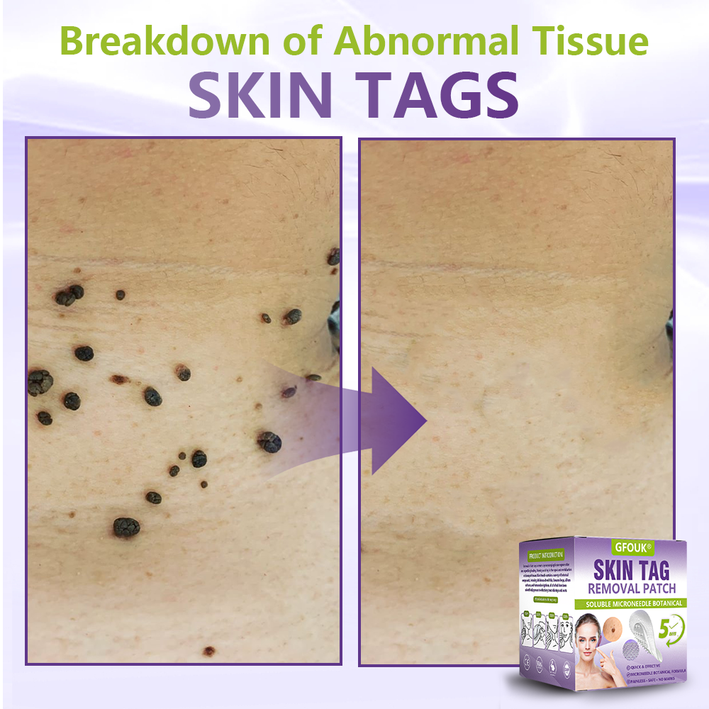Made and Shipped from Canada ✨GFOUK® Soluble Microneedle Botanical Skin Tag Removal Patch