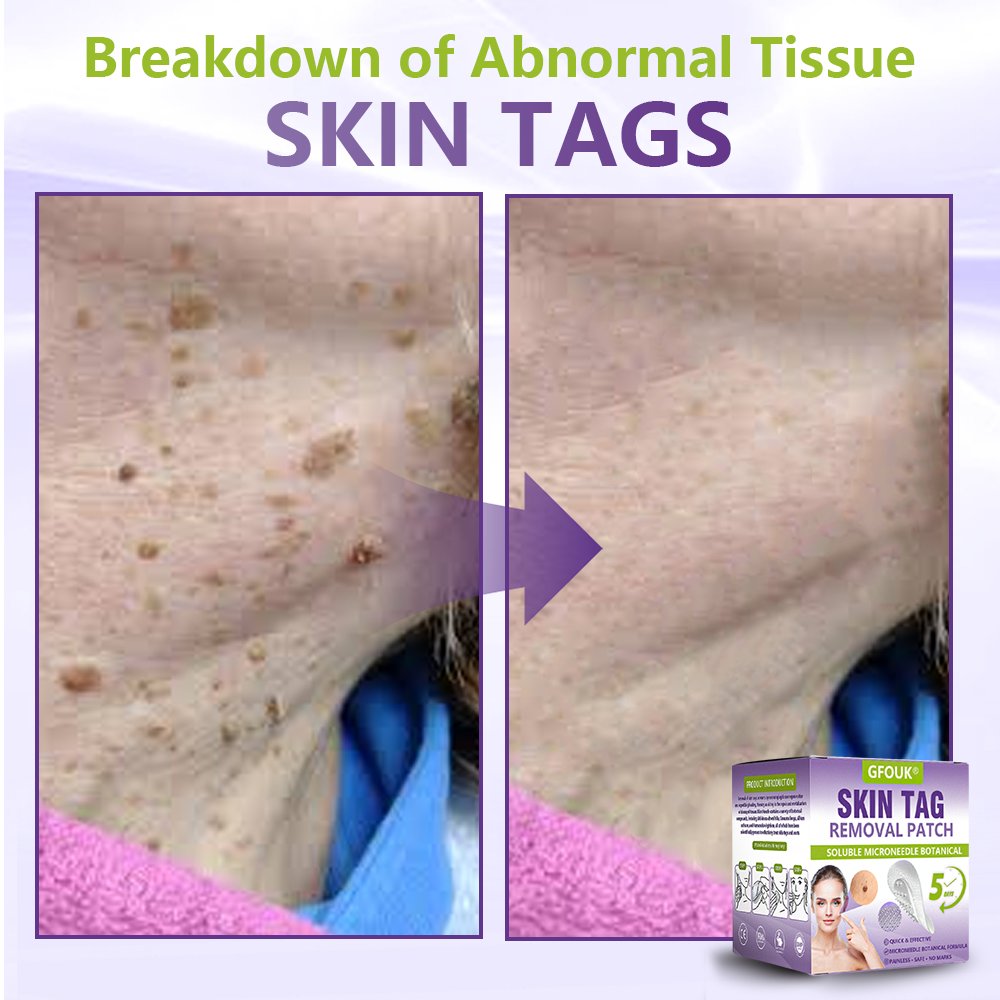 Made and Shipped from Canada ✨GFOUK® Soluble Microneedle Botanical Skin Tag Removal Patch